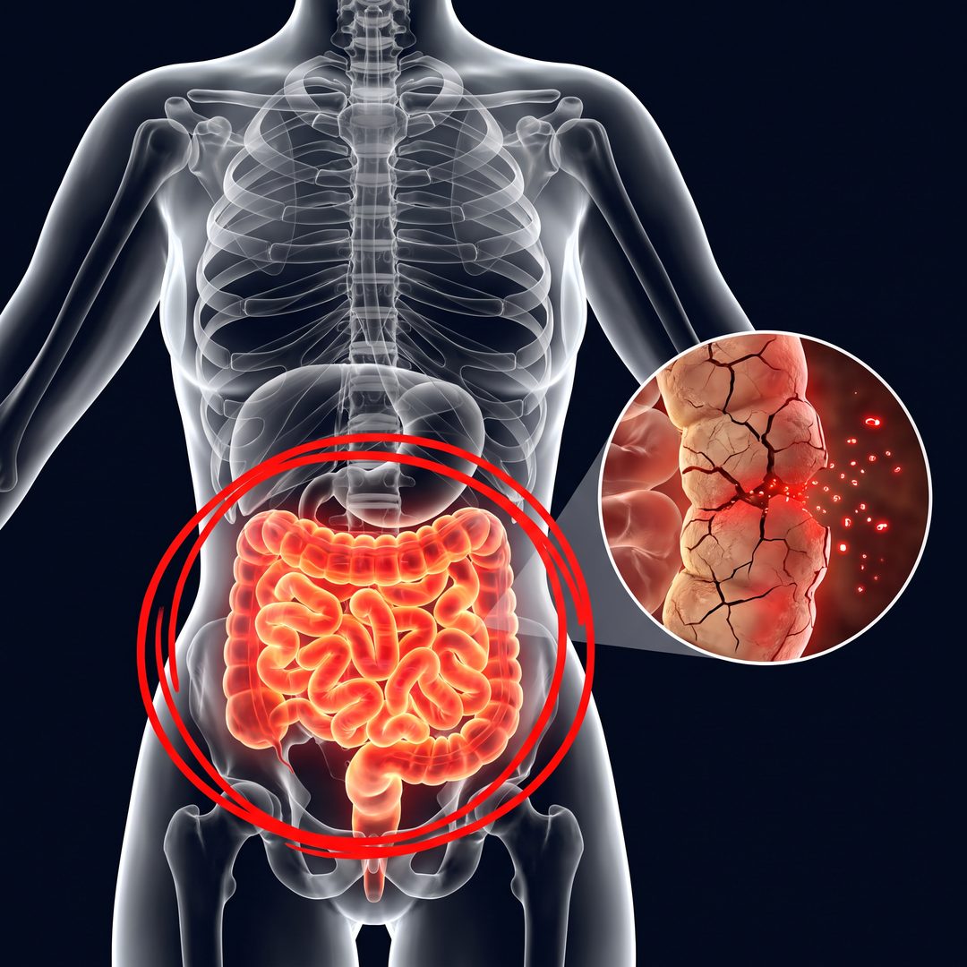 Inflamed red gut with a cracked gut lining